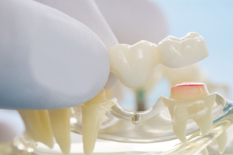 How Long Do Dental Bridges Last