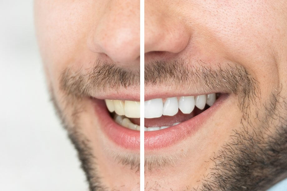 Can You Whiten Teeth If You Have Veneers or Fillings?