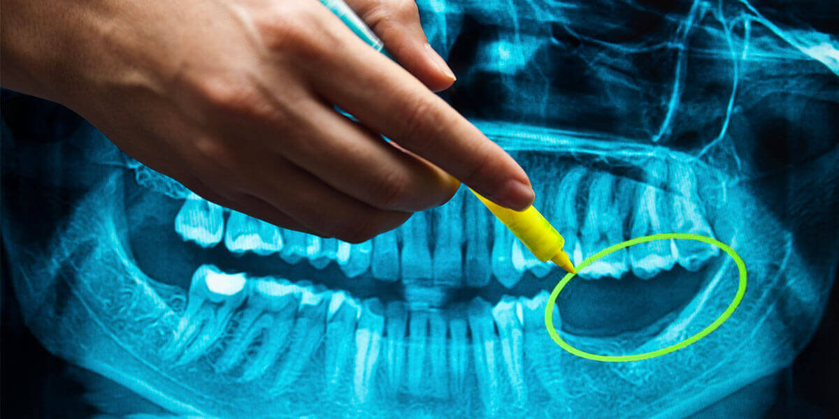 close-up of dental x-ray showing missing teeth