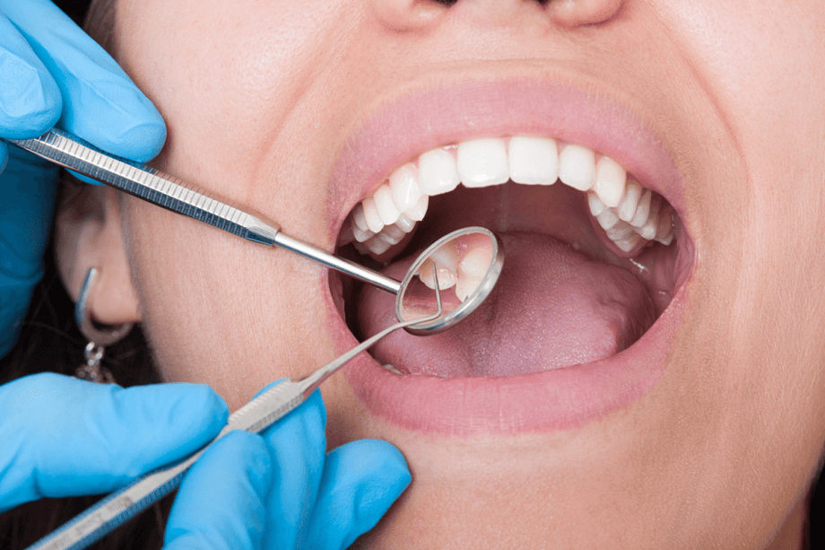 close-up of mouth with dental mirror