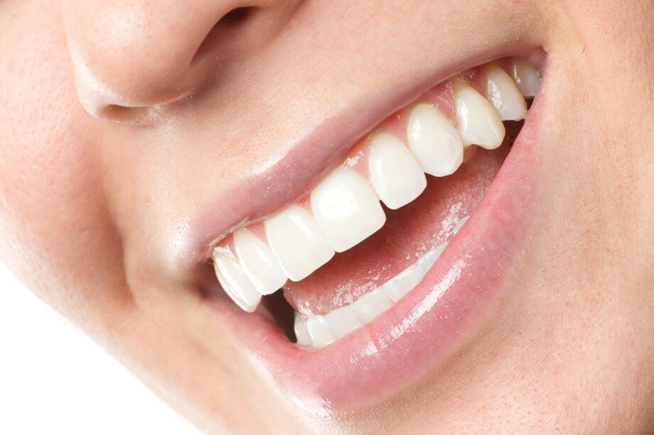 Veneers vs. Crowns: Find the Best Fit for Your Smile