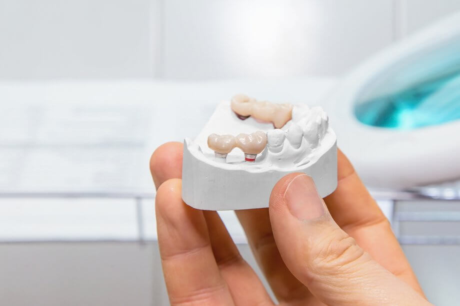 What Are The Different Types Of Dental Bridges?