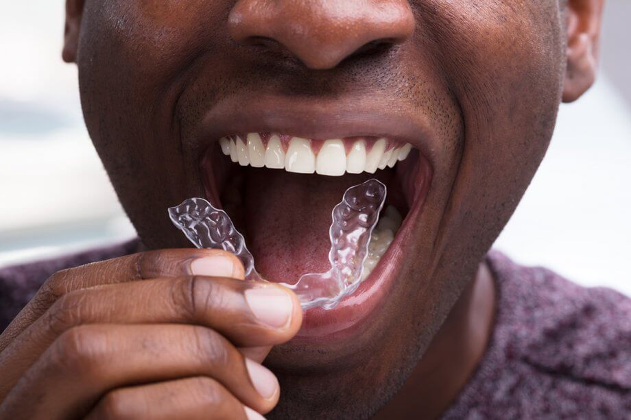 What Exactly Is Invisalign, and How Does It Work?